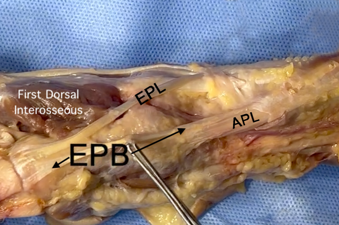 Extensor Pollicis Longus (EPL)