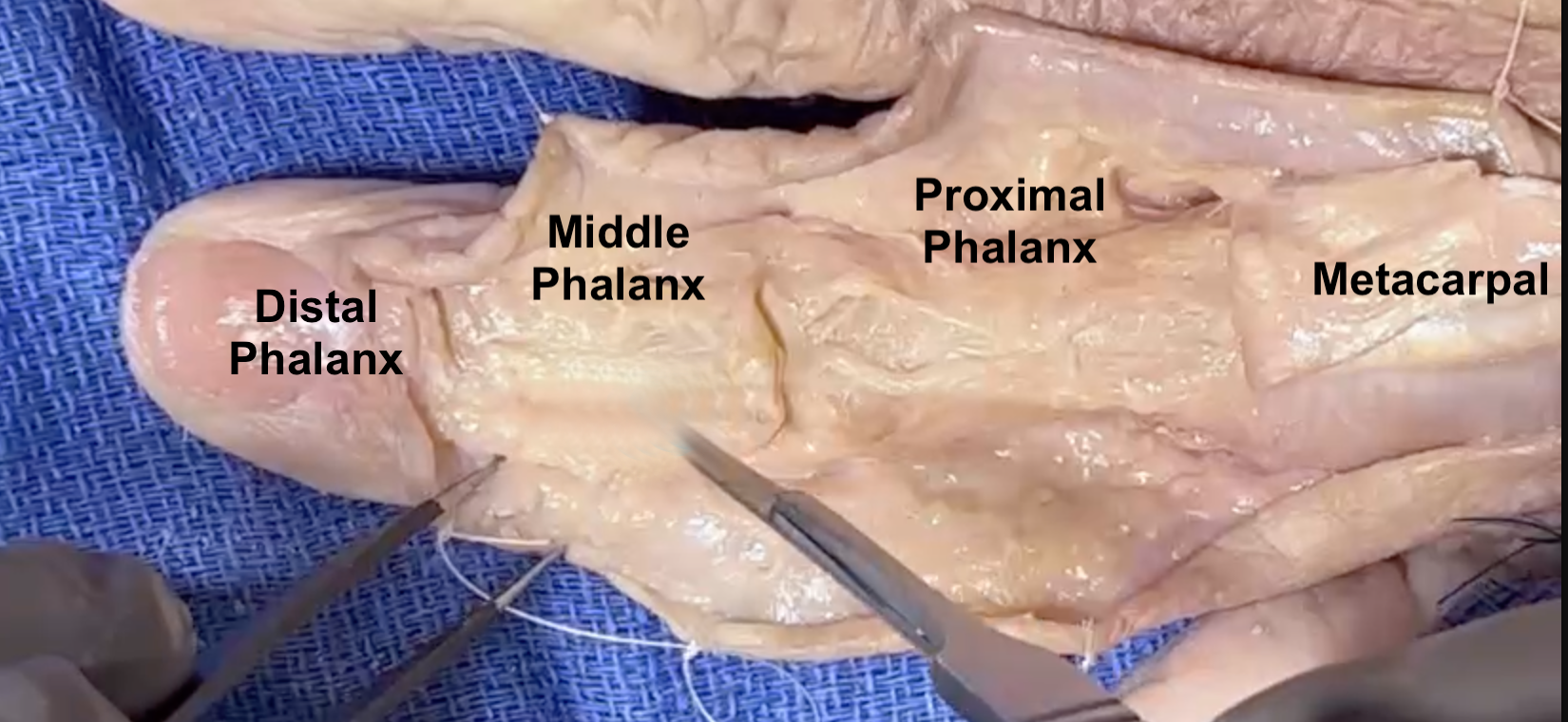 Anatomic Image of distal phalanx, middle phalanx, proximal phalanx, and metacarpals.