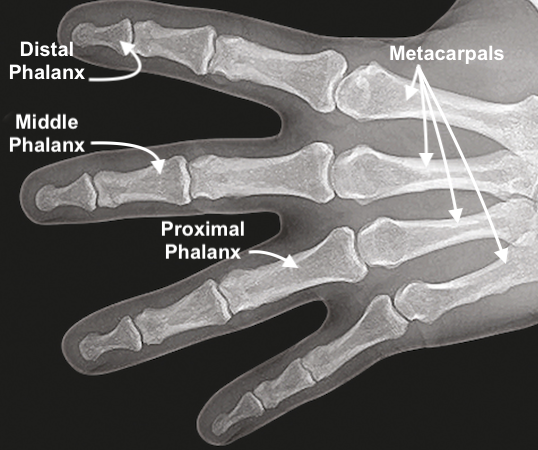 Normal X-ray Image of distal phalanx, middle phalanx, proximal phalanx, and metacarpals.