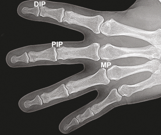 Normal X-ray Image of DIP Joint, PIP Joint and MP Joints.