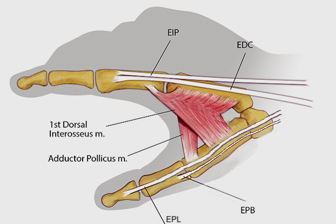 Note EPB, EPL, first dorsal interosseous, adductor pollicis, EDC, and EIP.