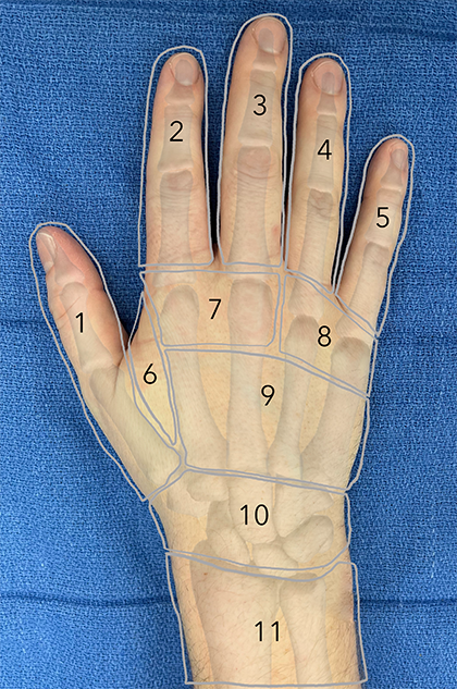 Image of dorsal hand with numbered zones