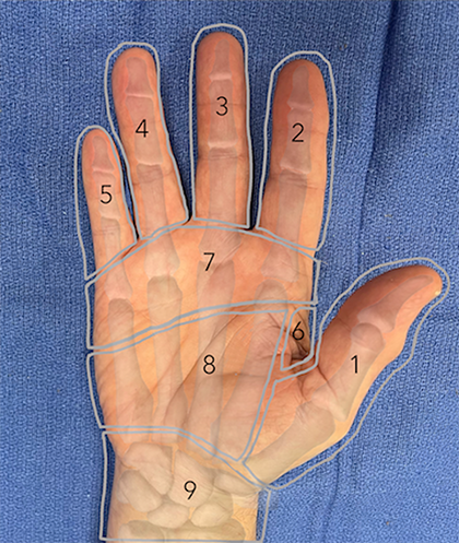 Image of palmar hand with numbered zones